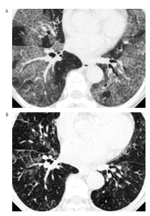 The high-resolution computed tomographic images of the chest show before (A) and after (B) treatment with inhaled granulocyte/macrophage–colony stimulating factor (GM-CSF) therapy for 24 weeks.